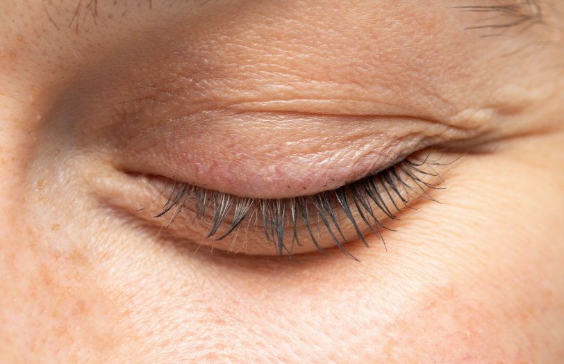 Oculoplastics treatment at Sapphire Eye Care