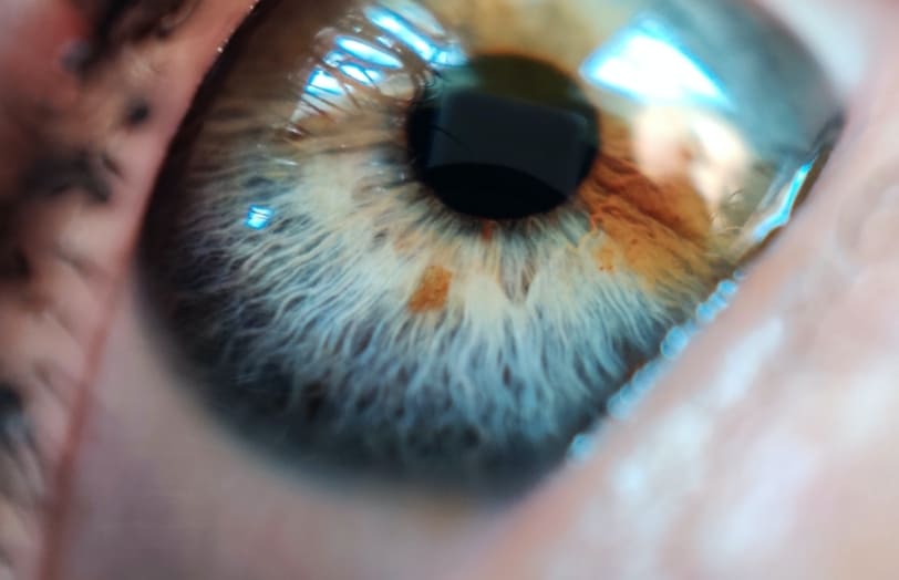Epiretinal Membrane at Sapphire Eye Care